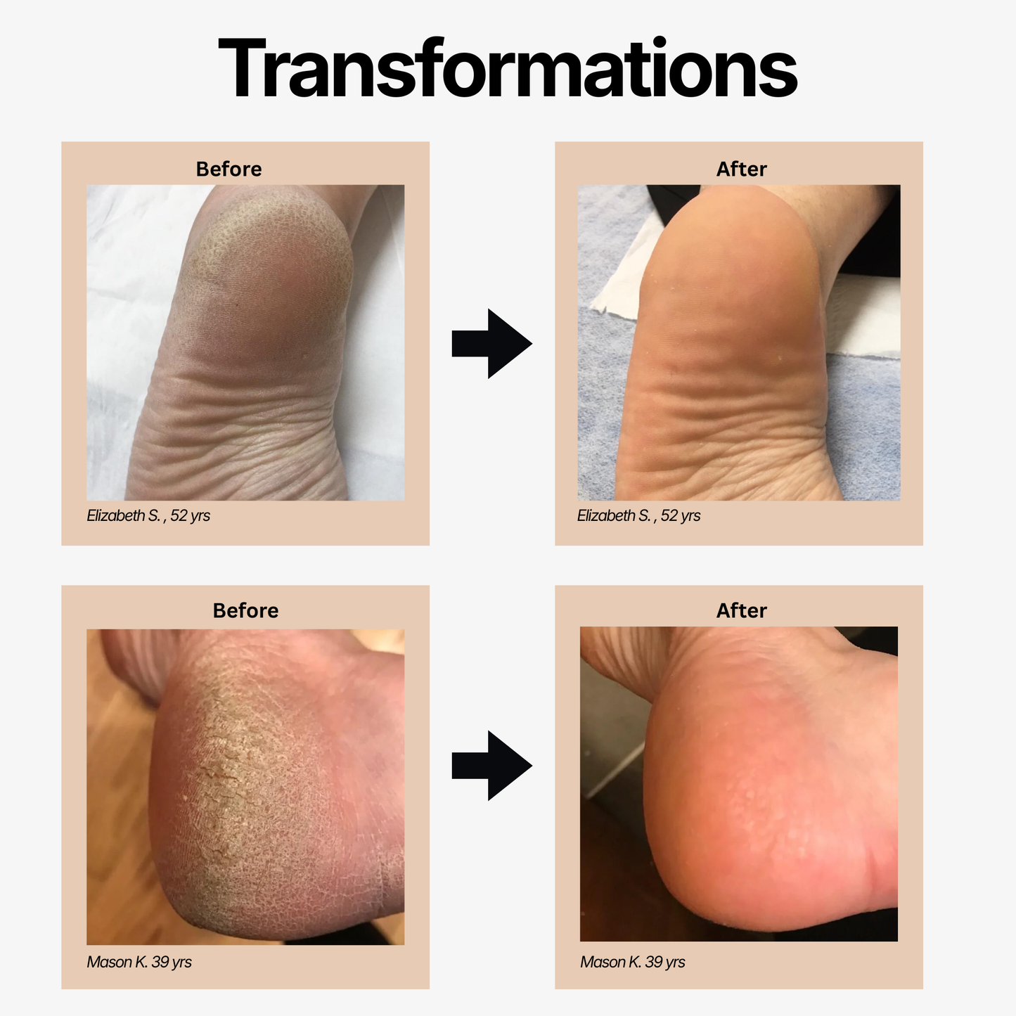 Solera Electric Callus Remover